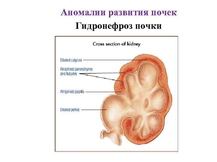 Аномалии развития почек Гидронефроз почки 
