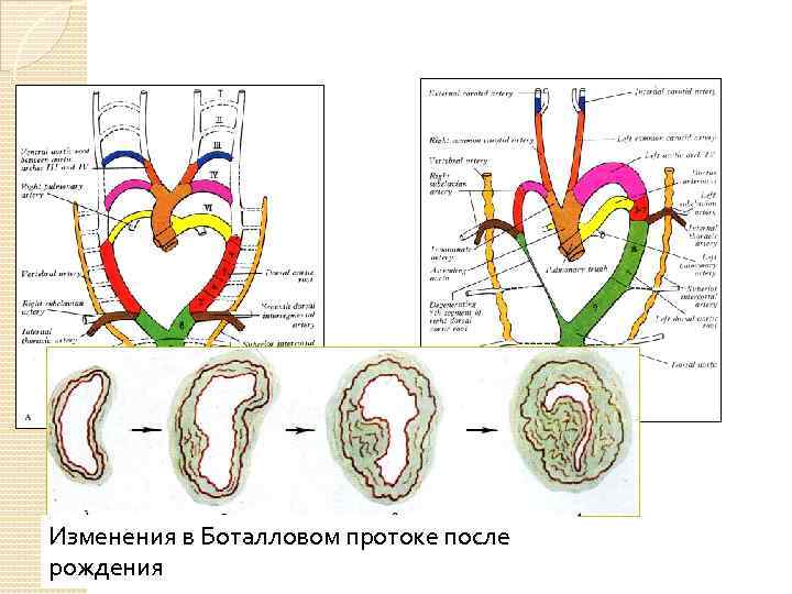 Изменения в Боталловом протоке после рождения 