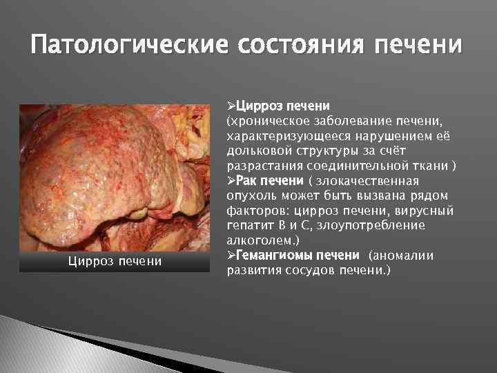 Патологические состояния печени Цирроз печени ØЦирроз печени (хроническое заболевание печени, характеризующееся нарушением её дольковой