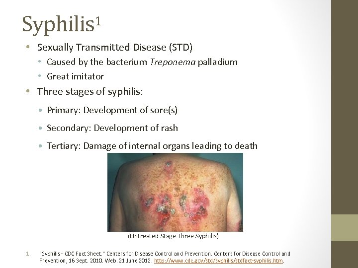 Syphilis 1 • Sexually Transmitted Disease (STD) • Caused by the bacterium Treponema palladium