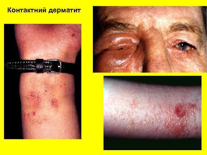Контактний дерматит 