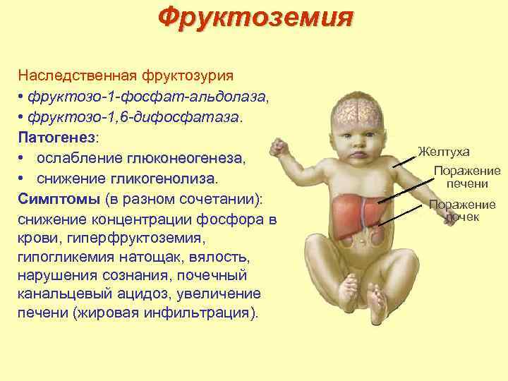 Фруктоземия Наследственная фруктозурия • фруктозо-1 -фосфат-альдолаза, • фруктозо-1, 6 -дифосфатаза. Патогенез: • ослабление глюконеогенеза,