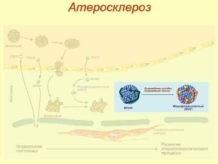 Атеросклероз 