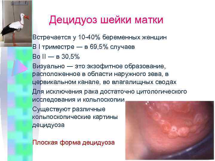 Децидуоз шейки матки Встречается у 10 -40% беременных женщин В I триместре ― в