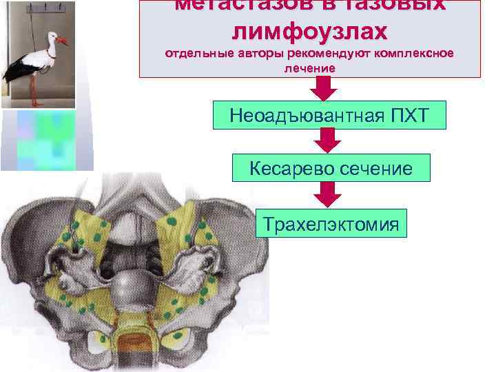 метастазов в тазовых лимфоузлах отдельные авторы рекомендуют комплексное лечение Неоадъювантная ПХТ Кесарево сечение Трахелэктомия