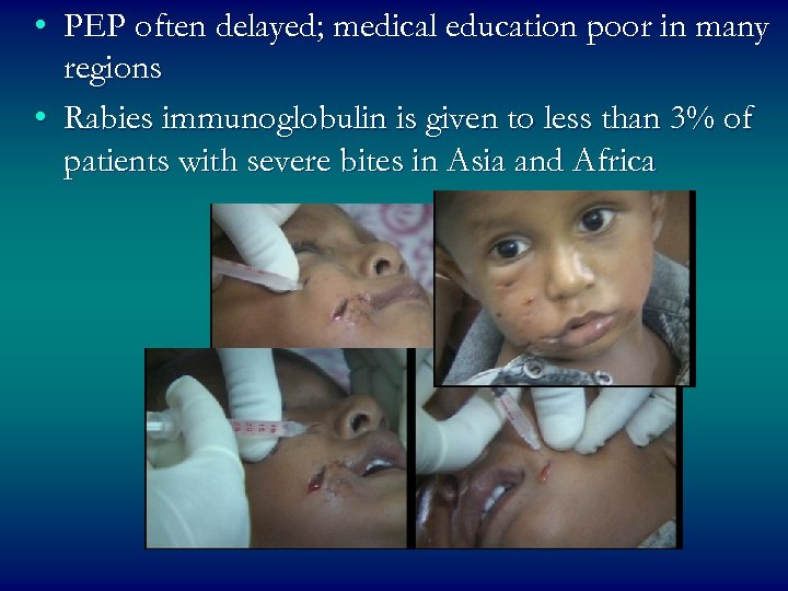  • PEP often delayed; medical education poor in many regions • Rabies immunoglobulin
