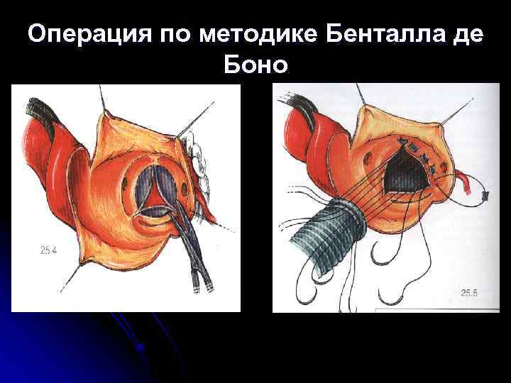 Операция по методике Бенталла де Боно 