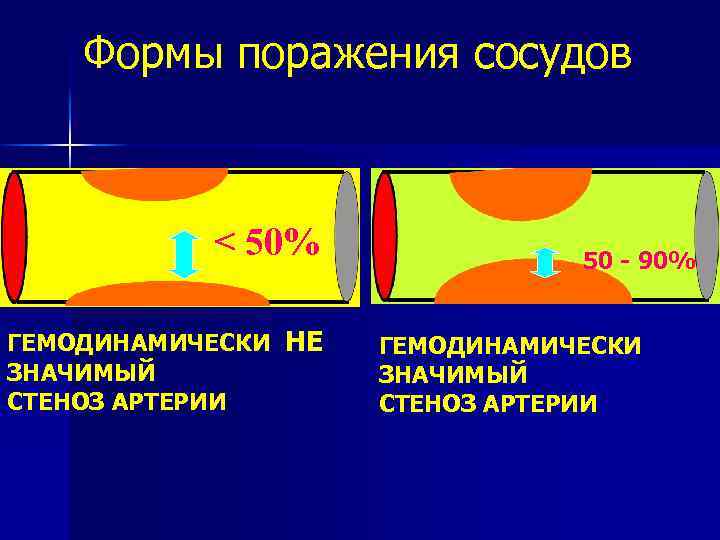 Эхографические признаки атеросклеротического. Гемодинамически значимые стенозы. Гемодинамически значимые стенозы брахиоцефальных артерий. Гемодинамически значимые атеросклеротические бляшки. Гемодинамически значимый стеноз магистральных артерий.