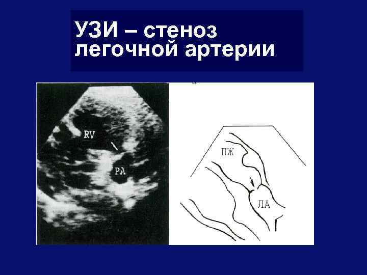 Стеноз легочной артерии у детей презентация