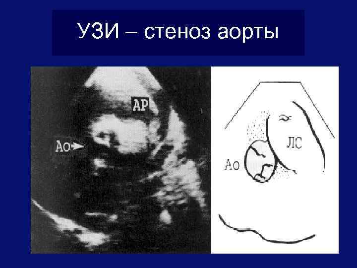 УЗИ – стеноз аорты 