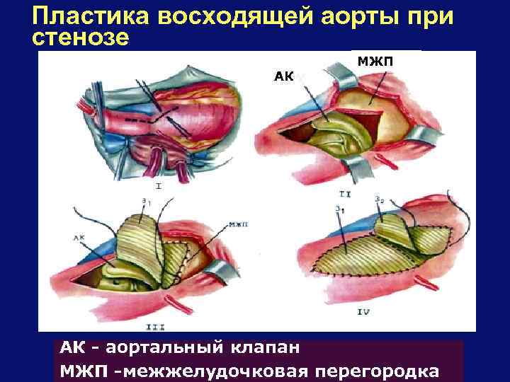 Пластика восходящей аорты при стенозе АК МЖП АК - аортальный клапан МЖП -межжелудочковая перегородка