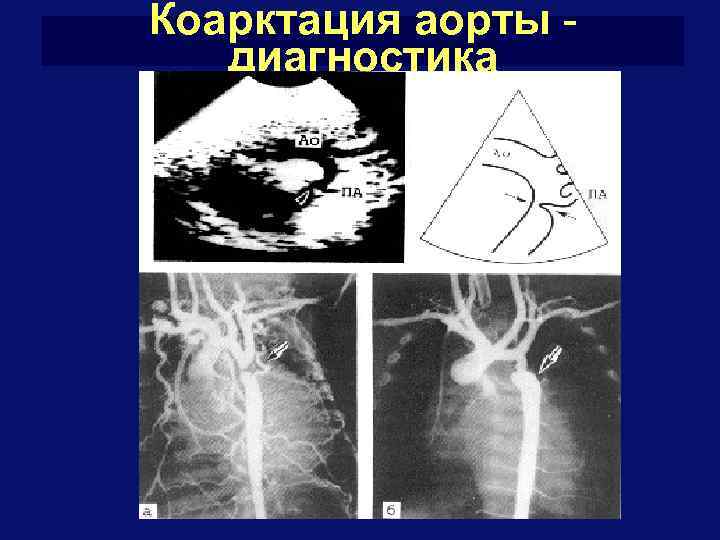 Коарктация аорты форум