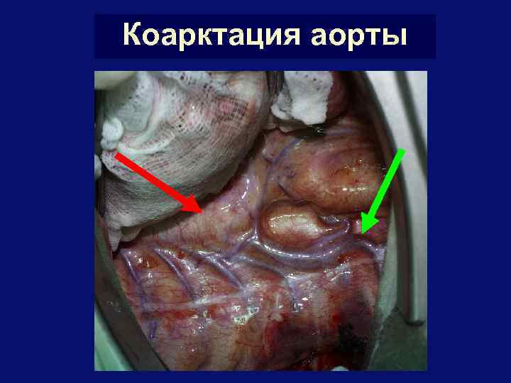 Коарктация аорты 