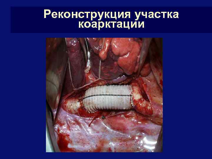 Реконструкция участка коарктации 