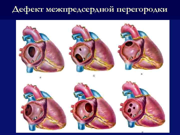 Дефект межпредсердной перегородки презентация