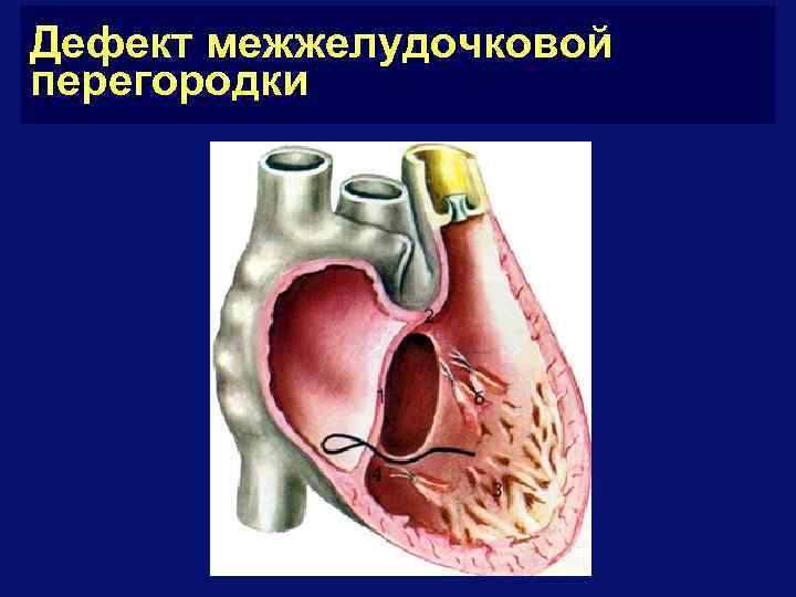 Дефект межжелудочковой перегородки у детей фото