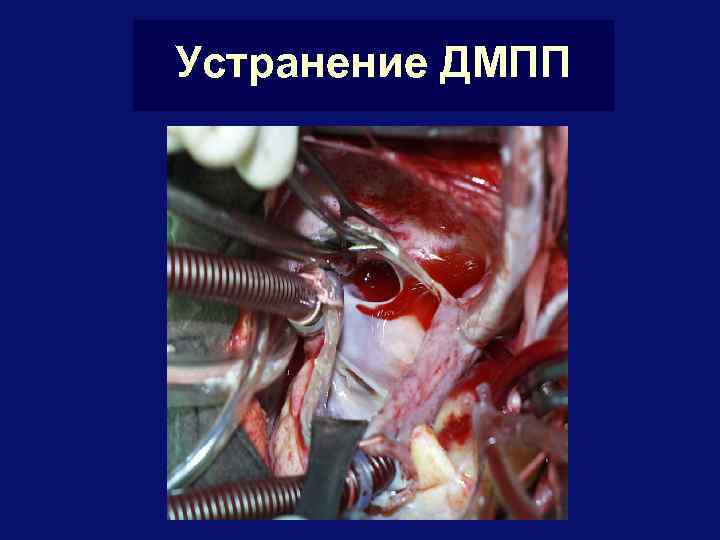 Устранение ДМПП 