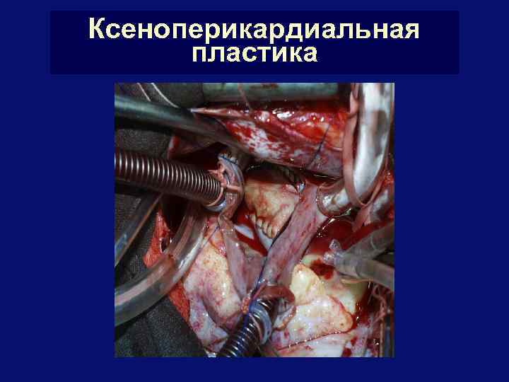 Ксеноперикардиальная пластика 