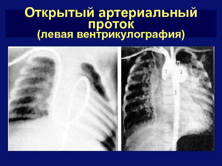 Открытый артериальный проток (левая вентрикулография) 