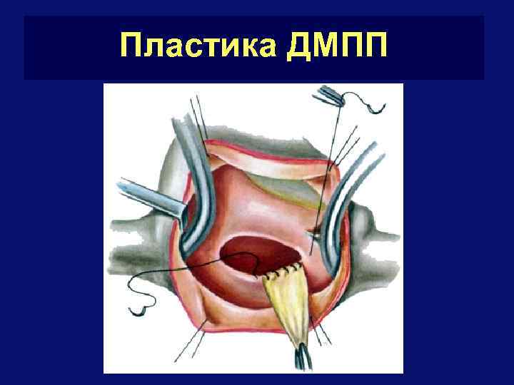 Пластика ДМПП 