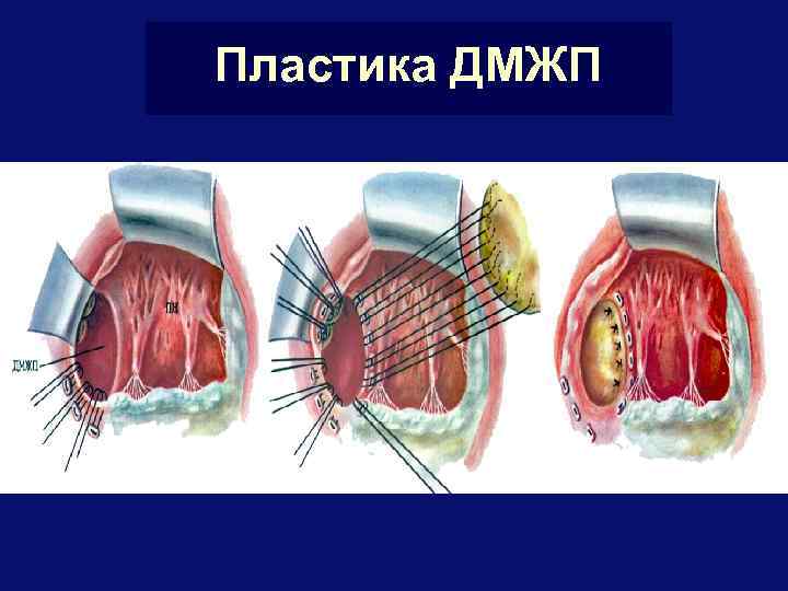 Пластика ДМЖП 
