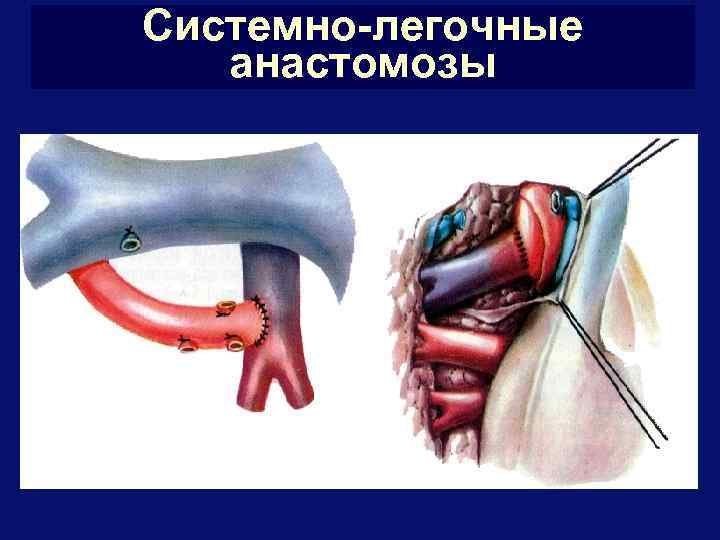 Системно-легочные анастомозы 