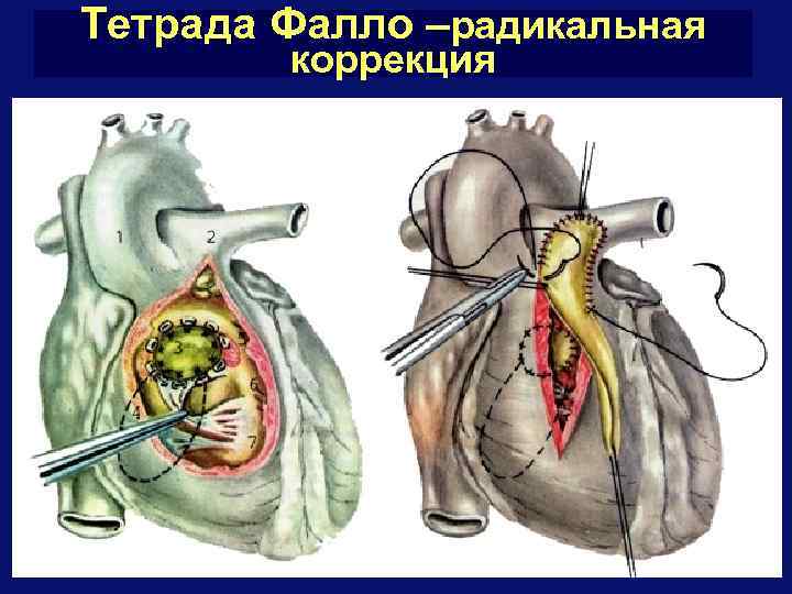 Тетрада Фалло –радикальная коррекция 