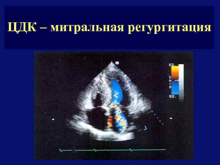 Митральная регургитация 2 степени. Регургитация ЦДК 0 1 степени ребенка.