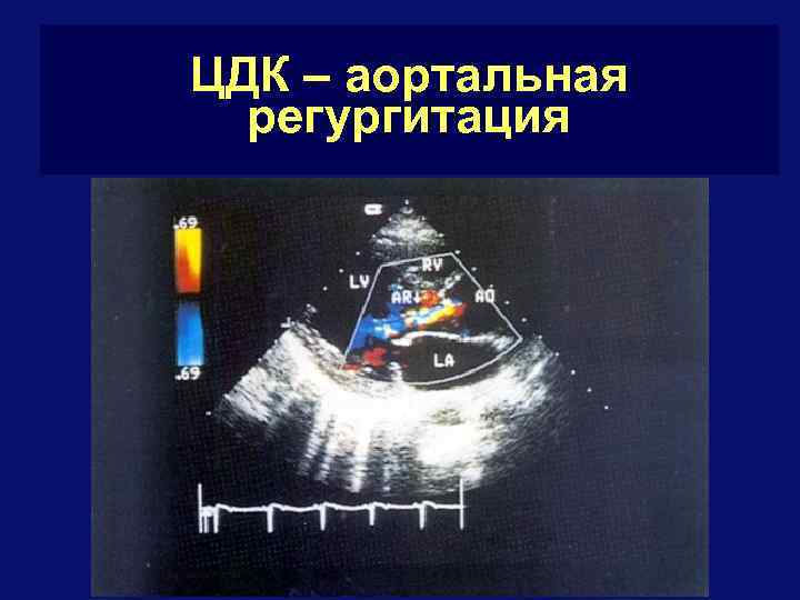 ЦДК – аортальная регургитация 