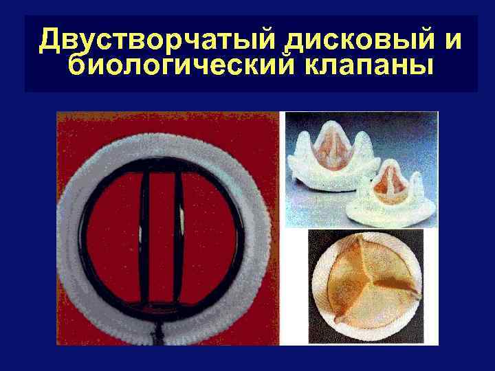 Двустворчатый дисковый и биологический клапаны 