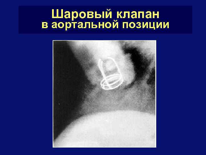 Шаровый клапан в аортальной позиции 