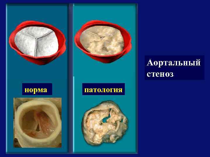 Аортальный стеноз норма патология 