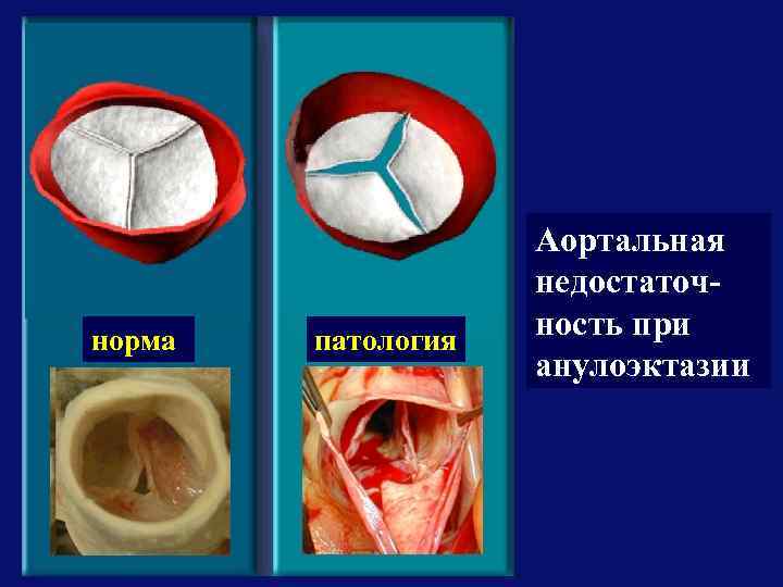 норма патология Аортальная недостаточность при анулоэктазии 