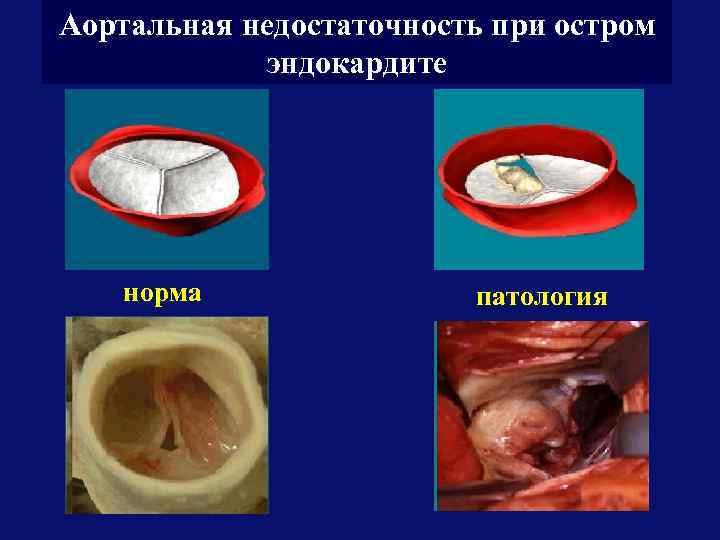 Аортальная недостаточность при остром эндокардите норма патология 