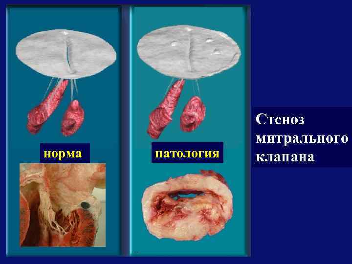 норма патология Стеноз митрального клапана 