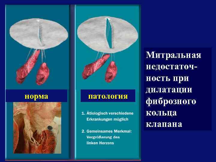 норма патология Митральная недостаточность при дилатации фиброзного кольца клапана 