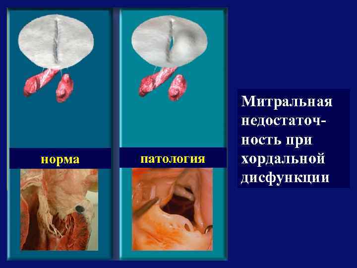 норма патология Митральная недостаточность при хордальной дисфункции 
