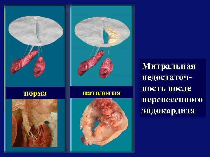 норма патология Митральная недостаточность после перенесенного эндокардита 