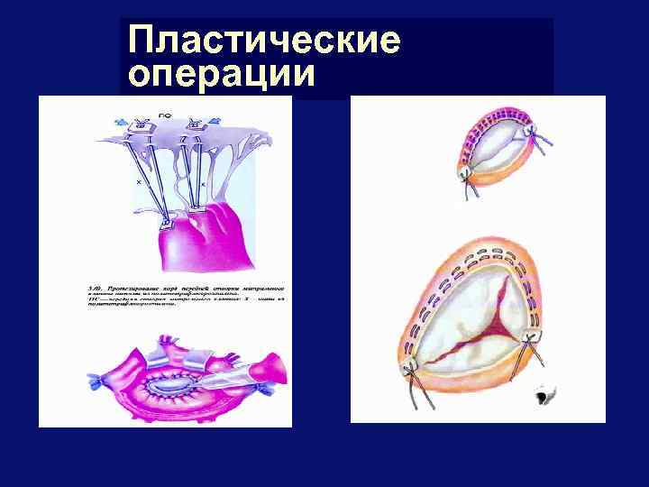 Пластические операции 
