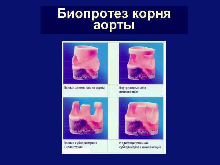 Биопротез корня аорты 