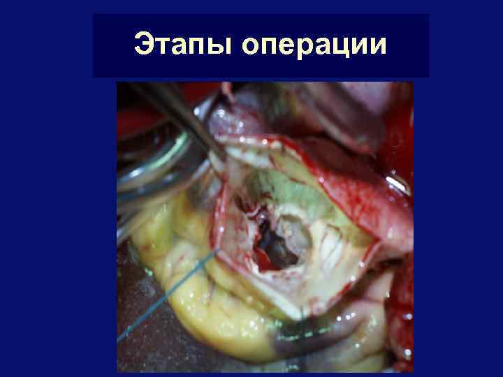 Этапы операции 