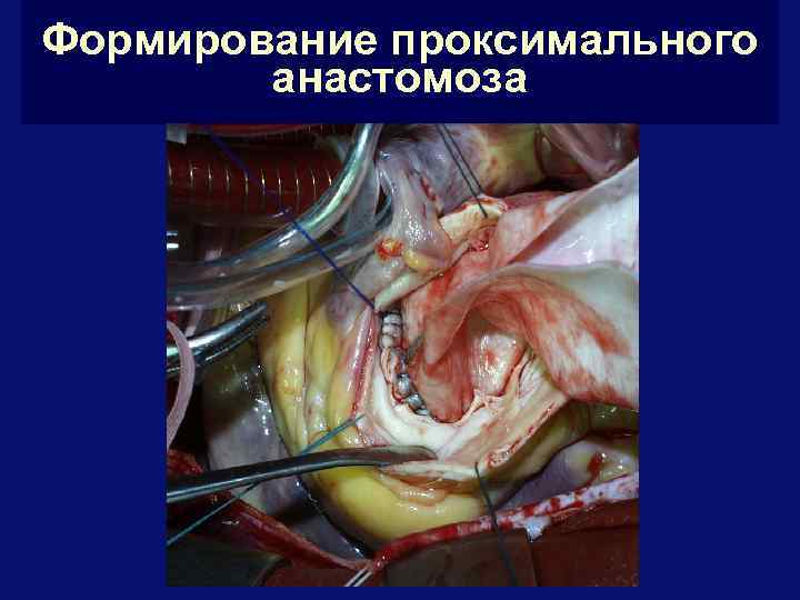 Формирование проксимального анастомоза 