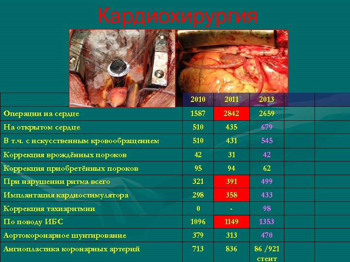 Кардиохирургия 2010 2011 2013 Операции на сердце 1587 2842 2659 На открытом сердце 510