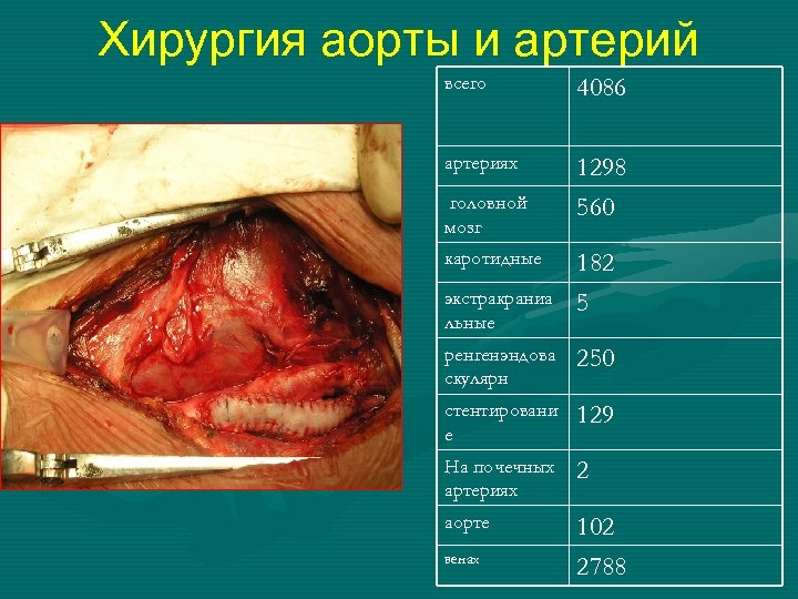 Хирургия аорты и артерий всего 4086 артериях 1298 560 головной мозг каротидные экстракраниа льные