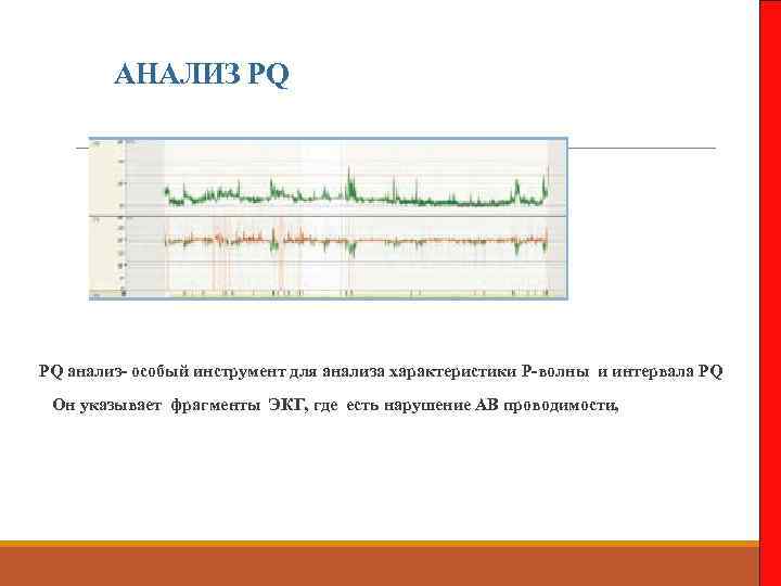 АНАЛИЗ PQ PQ анализ- особый инструмент для анализа характеристики Р-волны и интервала PQ Он