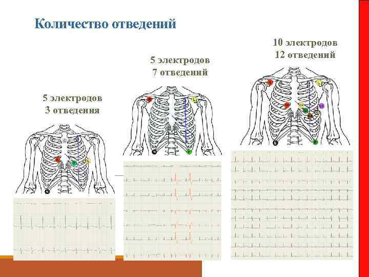 Количество отведений 5 электродов 7 отведений 5 электродов 3 отведения 10 электродов 12 отведений
