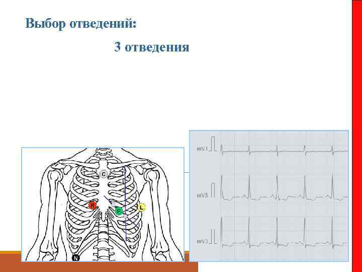 Выбор отведений: 3 отведения 