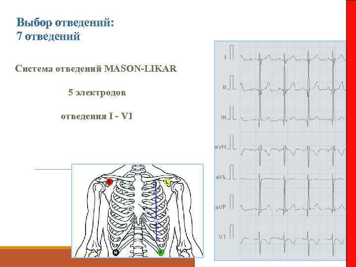 Выбор отведений: 7 отведений Система отведений MASON-LIKAR 5 электродов отведения I - V 1