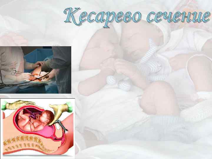 Кесарево сечение 