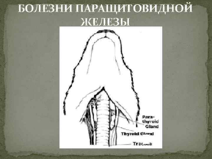 БОЛЕЗНИ ПАРАЩИТОВИДНОЙ ЖЕЛЕЗЫ 